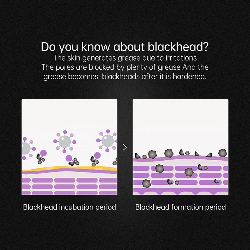 Blackhead Treatment Peeling Mask