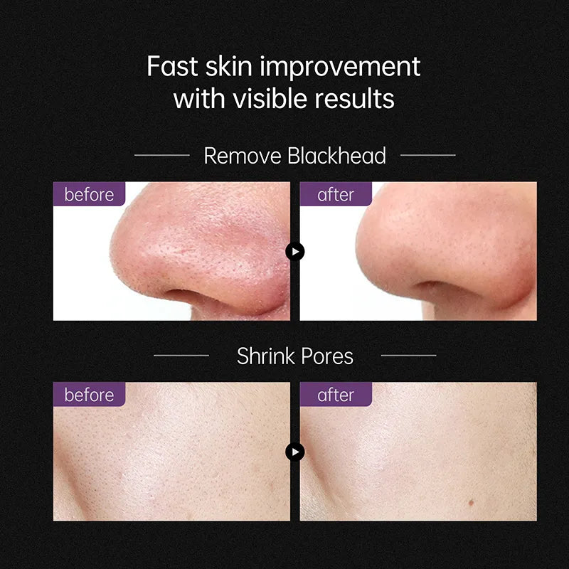 Blackhead Treatment Peeling Mask