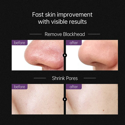 Blackhead Treatment Peeling Mask